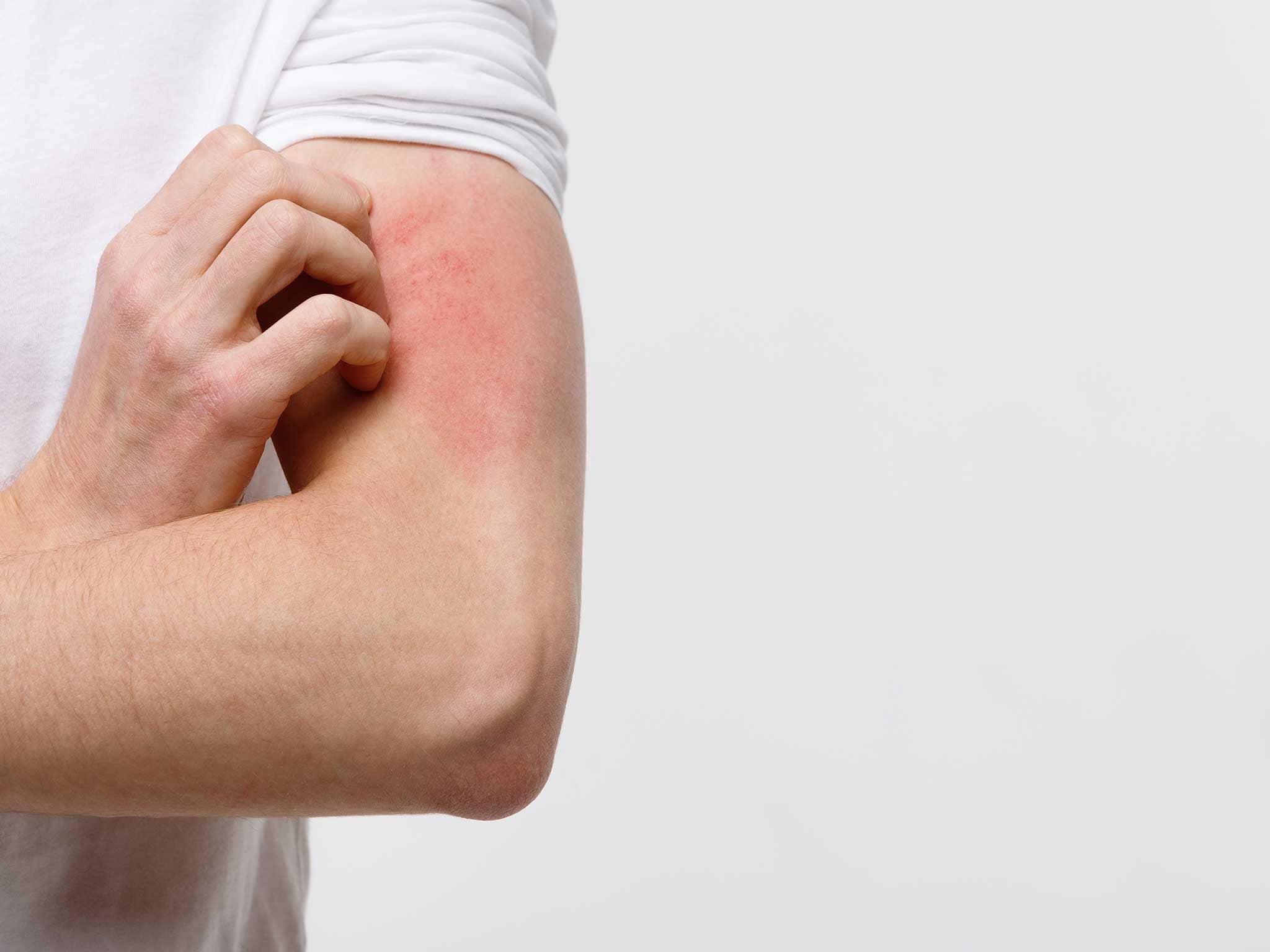 Natural treatment for Skin Problems